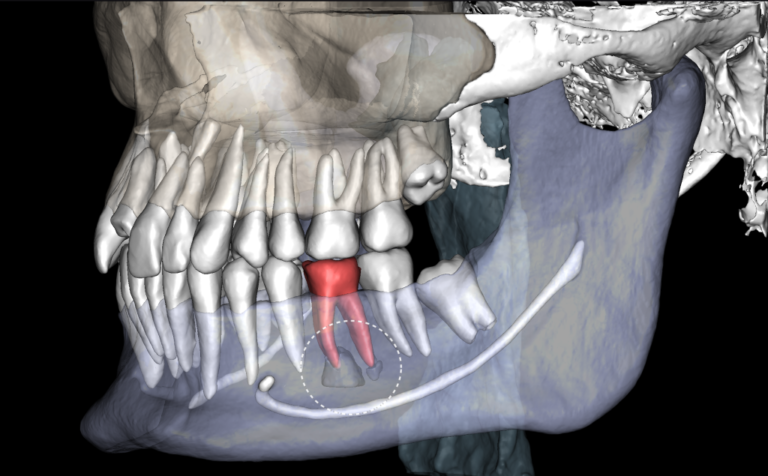 Endodoncja — analiza kanałów korzeniowych