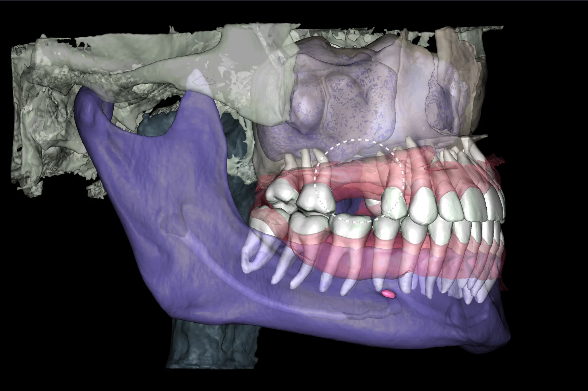 Implantologia — planowanie implantów
